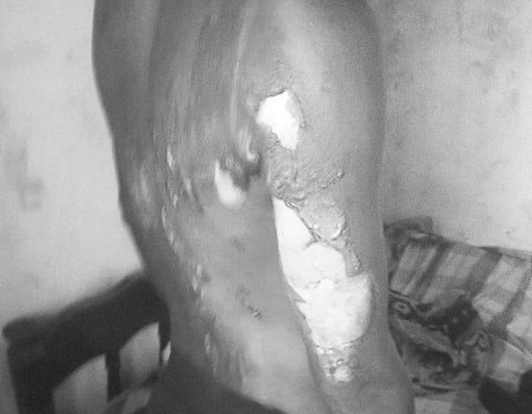 Three tortured and burned in Makueni for failing to attend Family gathering