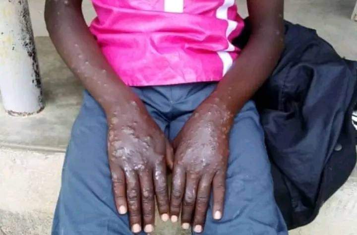 Makueni County Records First Monkey Pox Case